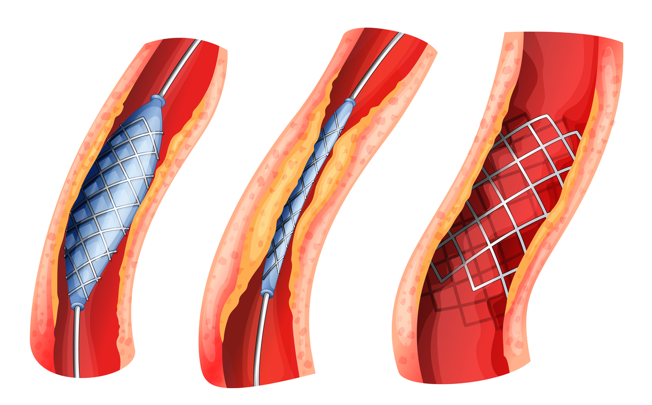 Graphics of a stent placement in an artery