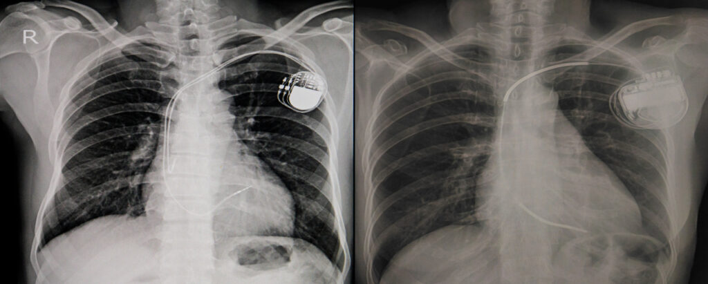 X-Ray of a person with a permanent pacemaker insertion