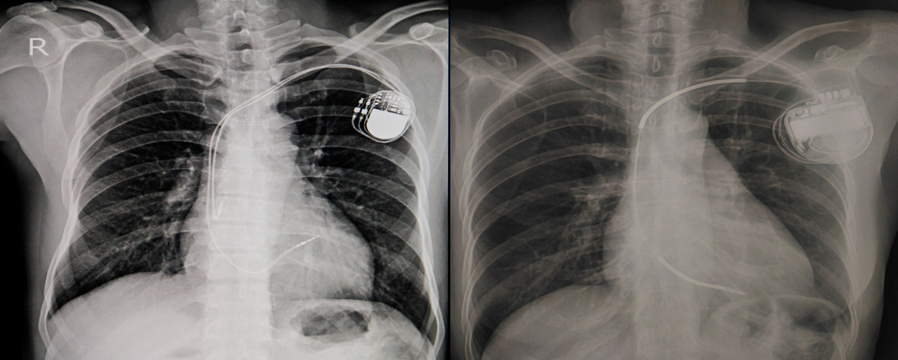 X-Ray of a person with a permanent pacemaker insertion