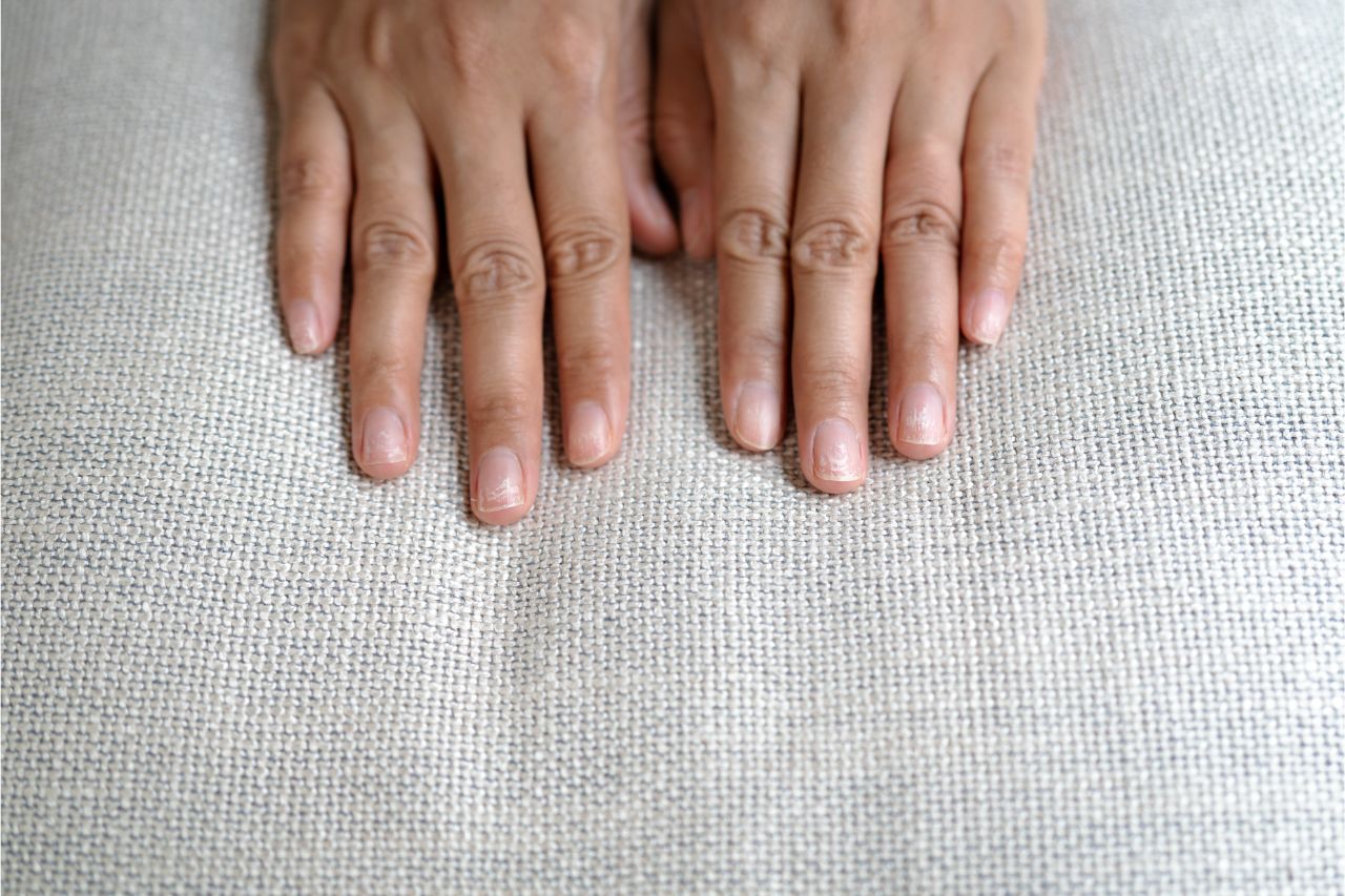 Brittle Fingernails