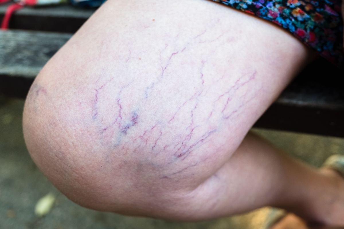 What causes varicose veins?