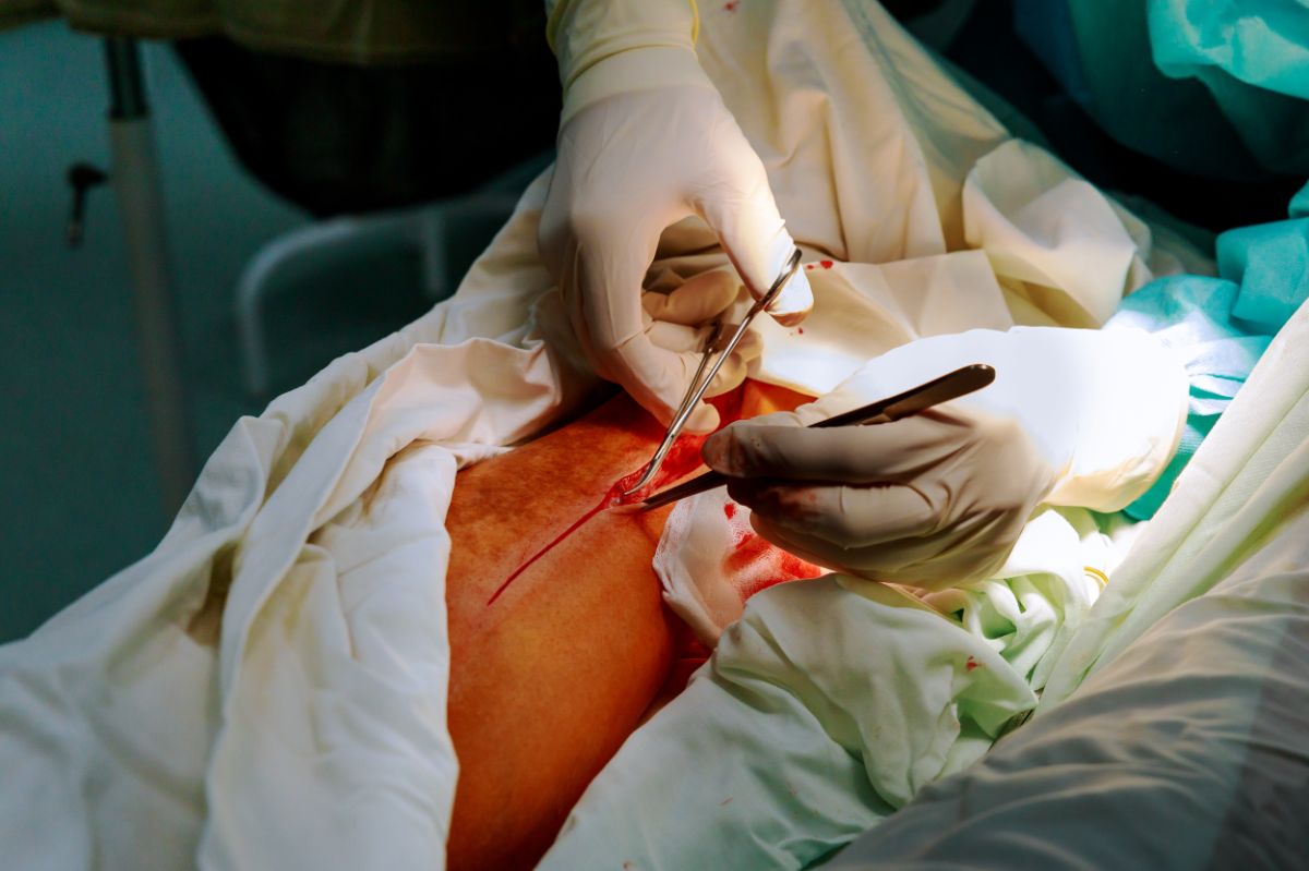 Undergoing vein surgery